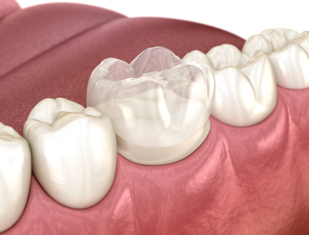 🦷 Cracked Teeth: How Retainers Protect You