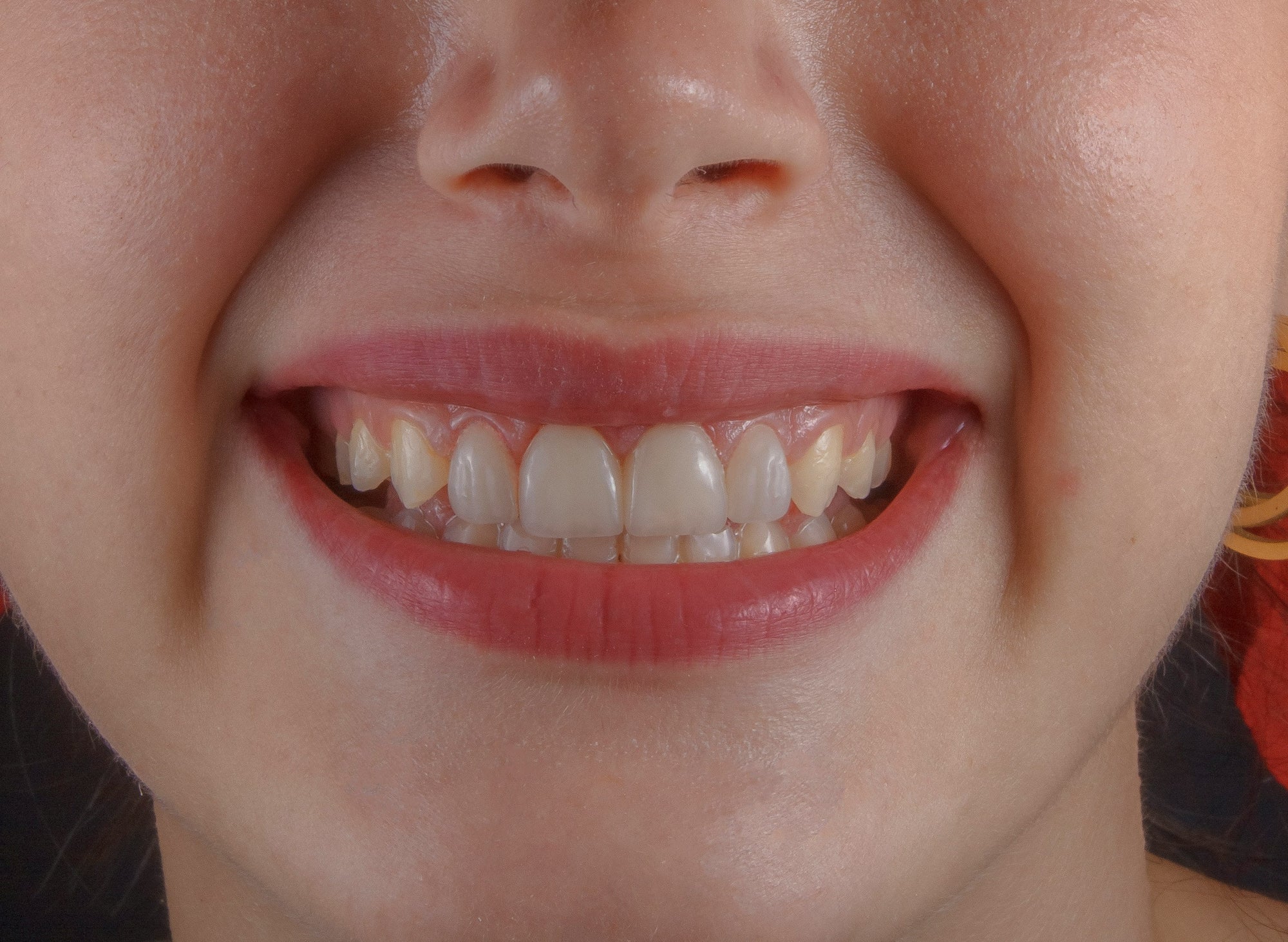 Fashion, Function, Fear: The Cultural Evolution of the Retainer