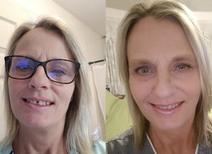 Fixing Gap in Front Teeth with Clear Aligners